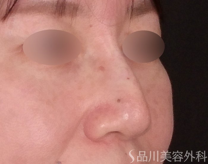 症例NO.71374のAFTER写真