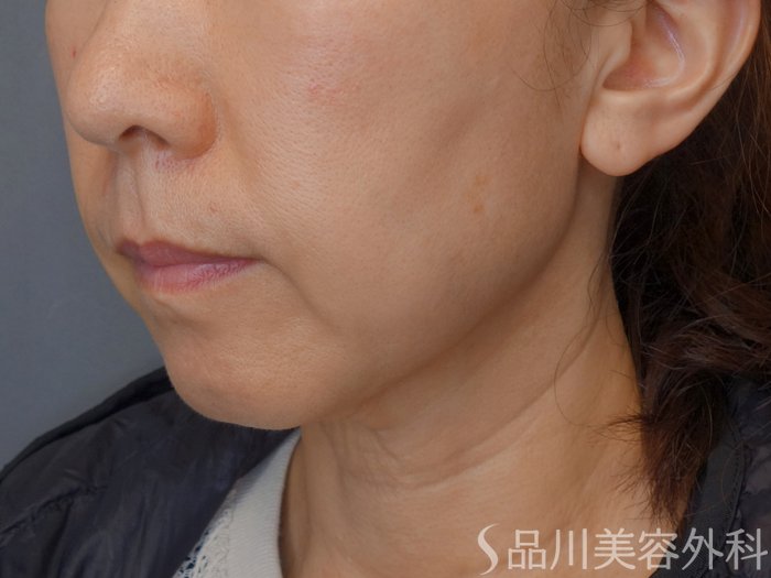 症例NO.72423のBEFORE写真