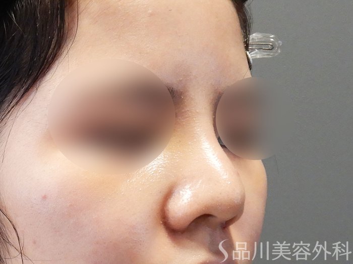 症例NO.71066のAFTER写真