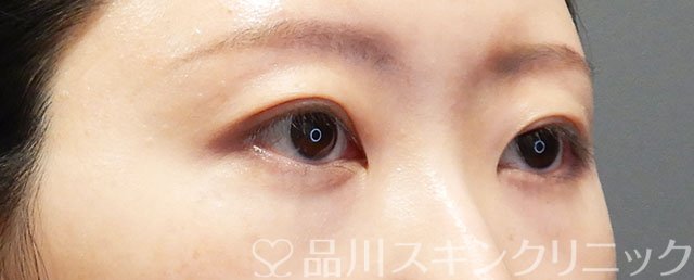 症例NO.73381のAFTER写真