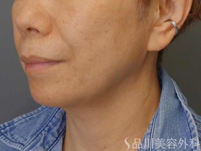 症例NO.70817のBEFORE写真