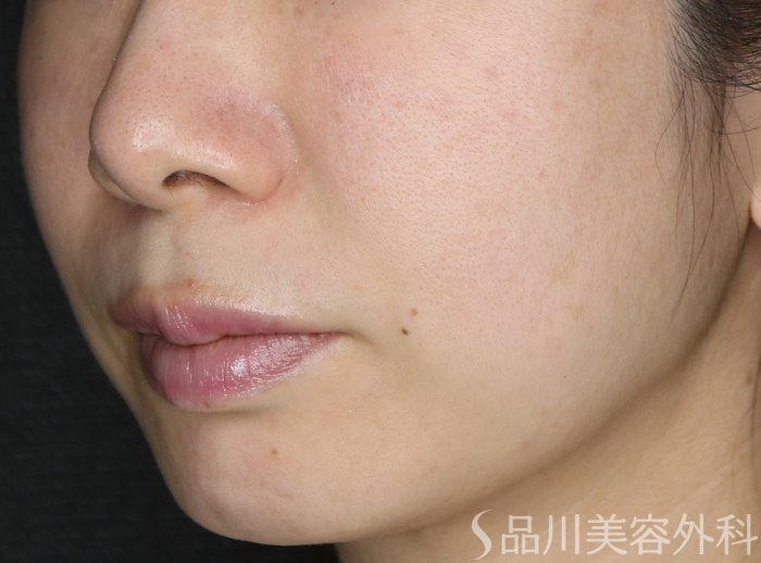 症例NO.69904のBEFORE写真