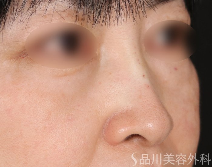 症例NO.74207のAFTER写真