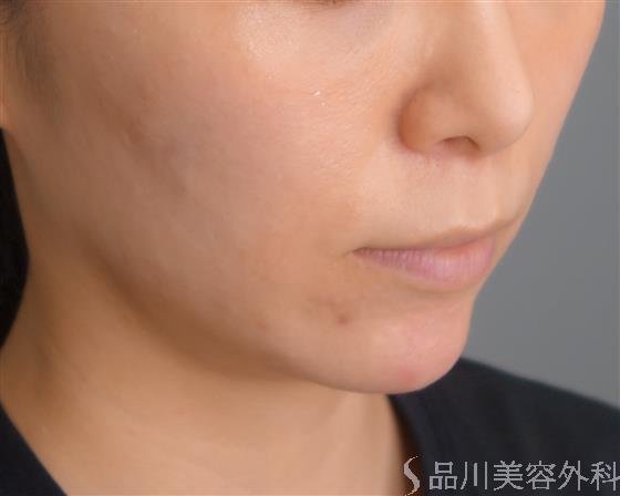 症例NO.51728のAFTER写真