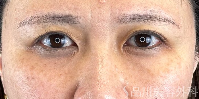 症例NO.70619のBEFORE写真
