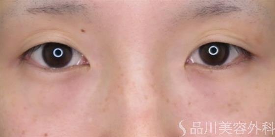 症例NO.48734のBEFORE写真