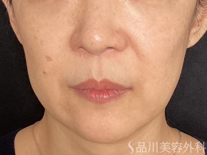症例NO.65606のBEFORE写真