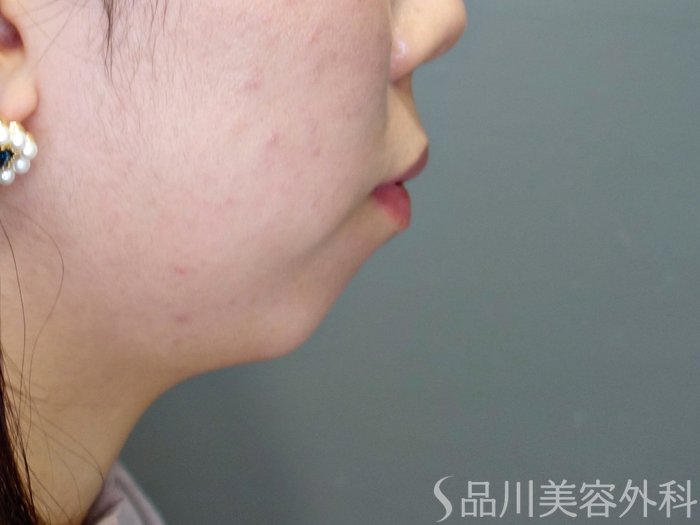 症例NO.69506のBEFORE写真