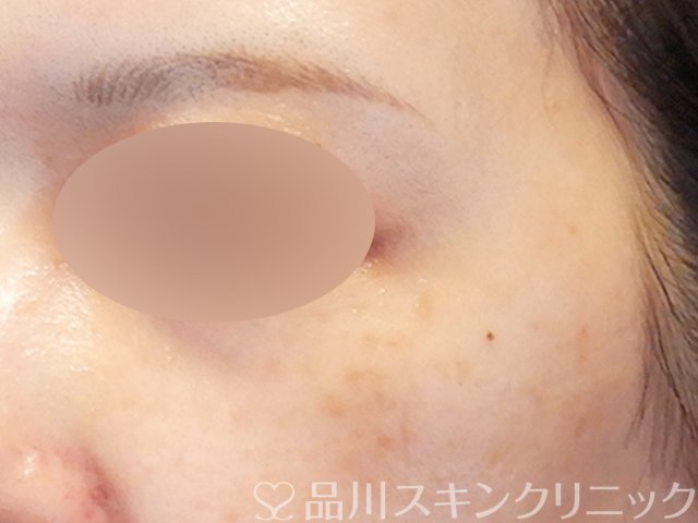 症例NO.68612のAFTER写真