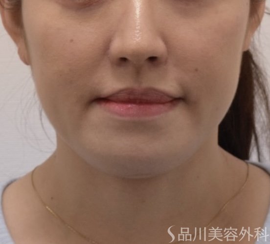 症例NO.71659のBEFORE写真