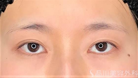 症例NO.61273のAFTER写真