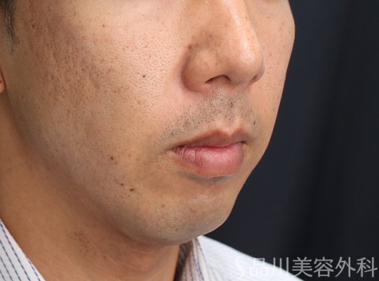 症例NO.71784のAFTER写真