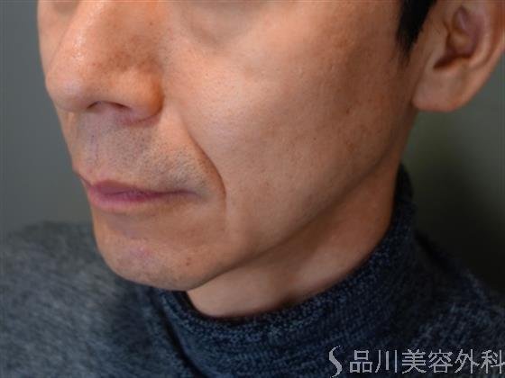 症例NO.49784のBEFORE写真