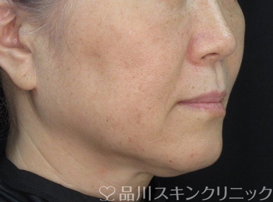 症例NO.71218のAFTER写真