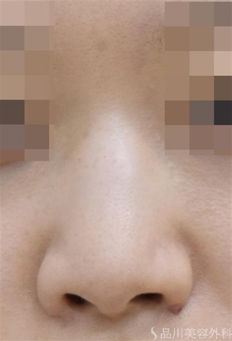症例NO.42880のBEFORE写真
