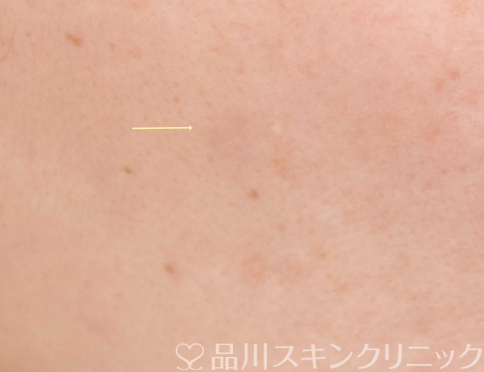 症例NO.69996のAFTER写真