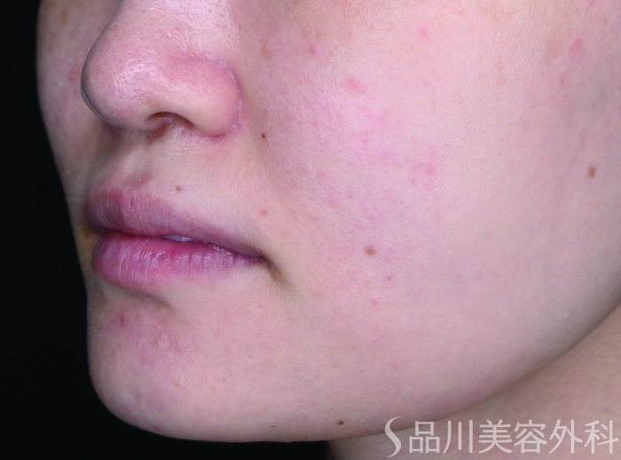 症例NO.75240のBEFORE写真