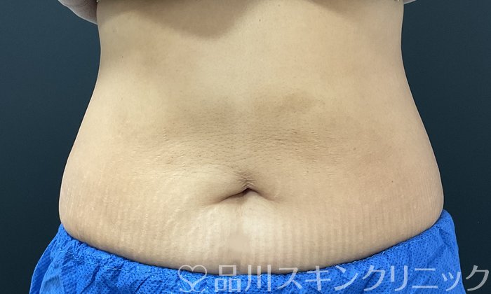 症例NO.74641のAFTER写真