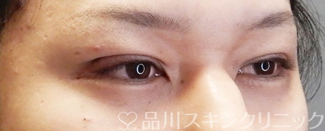 症例NO.73025のAFTER写真