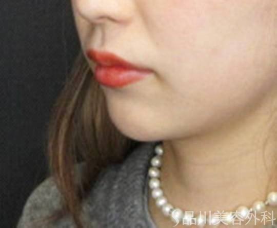 症例NO.72664のBEFORE写真