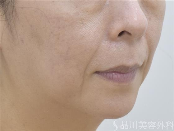 症例NO.48021のBEFORE写真