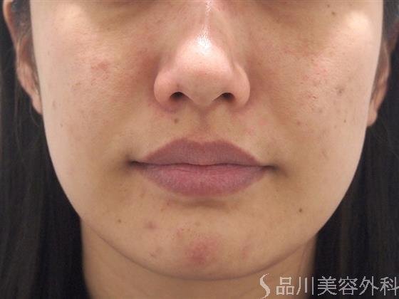症例NO.21508のAFTER写真
