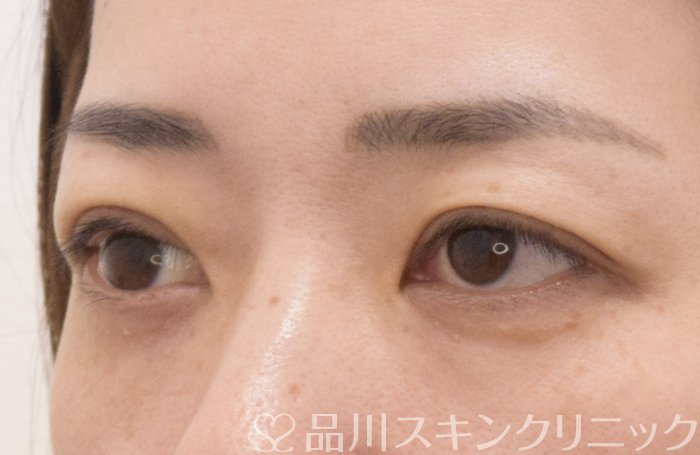 症例NO.70969のAFTER写真