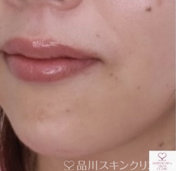 症例NO.68043のAFTER写真