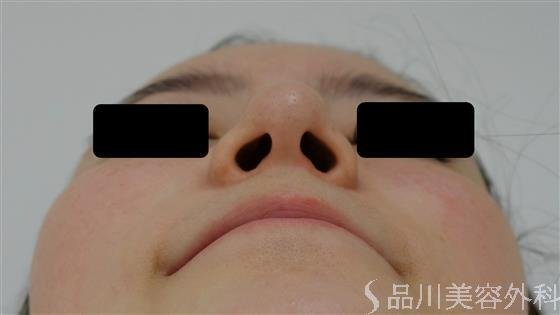 症例NO.36846のBEFORE写真