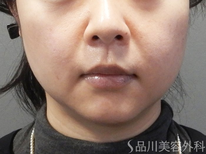症例NO.69445のAFTER写真