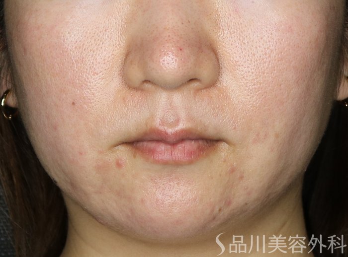 症例NO.72204のAFTER写真