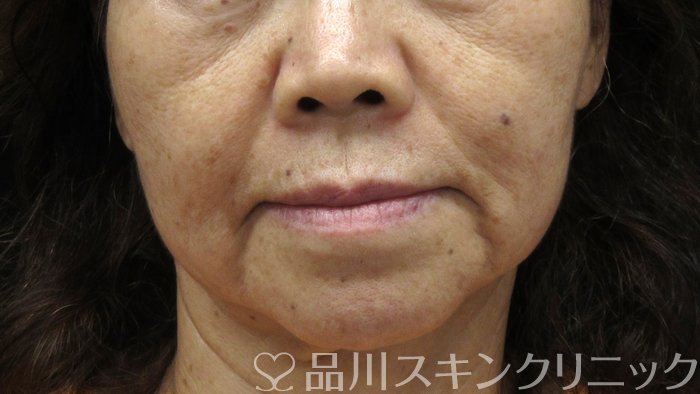 症例NO.73190のBEFORE写真