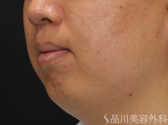 症例NO.74776のBEFORE写真
