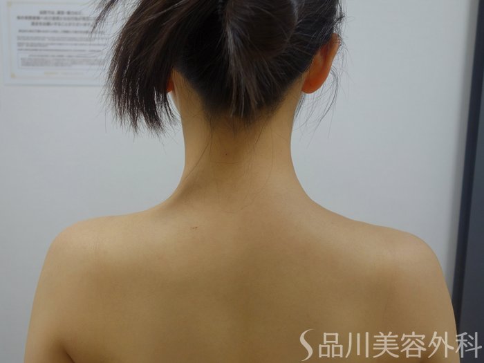 症例NO.73363のAFTER写真