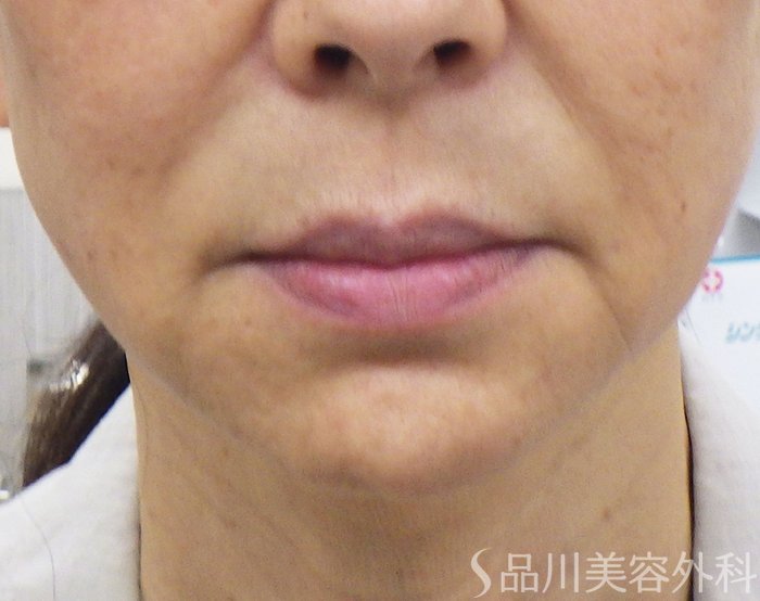 症例NO.71735のBEFORE写真
