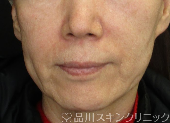 症例NO.73166のBEFORE写真