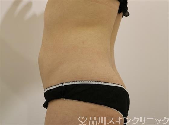 症例NO.43971のAFTER写真