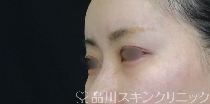 症例NO.70892のBEFORE写真