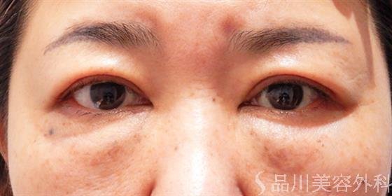 症例NO.53706のAFTER写真
