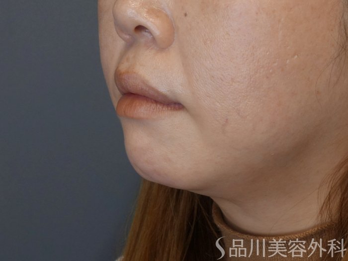 症例NO.70434のBEFORE写真