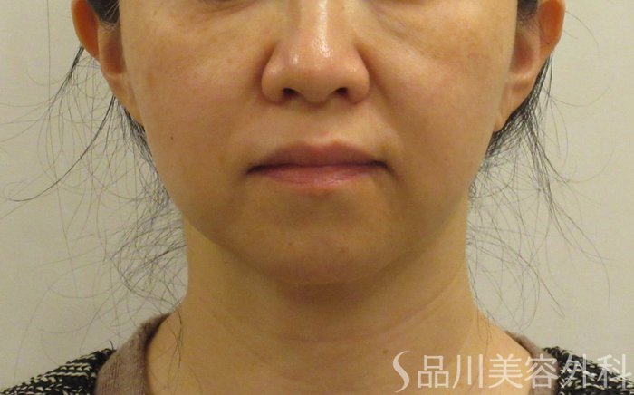 症例NO.69439のBEFORE写真
