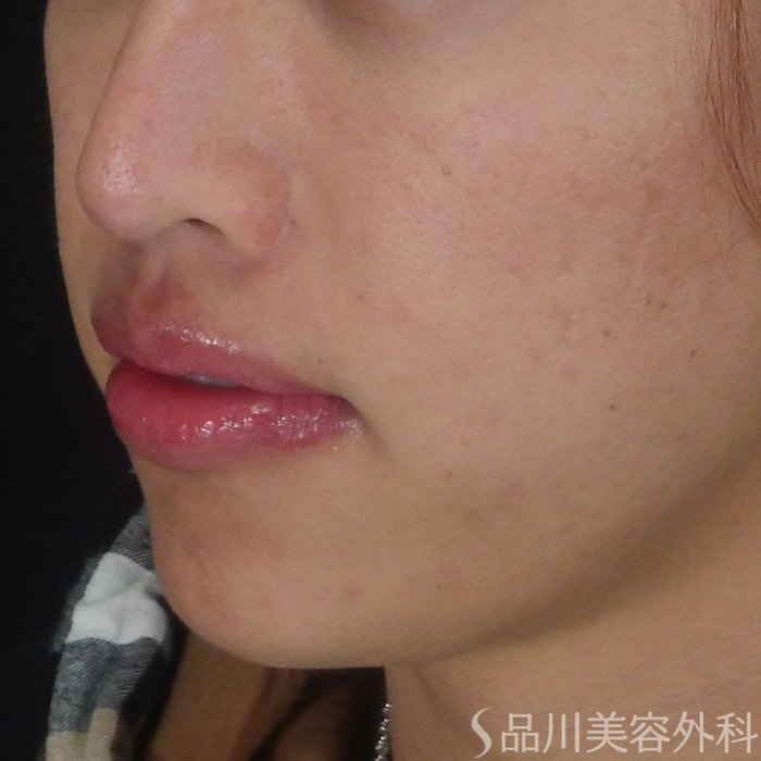 症例NO.70833のBEFORE写真