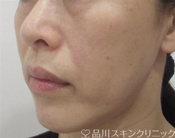 症例NO.31214のAFTER写真
