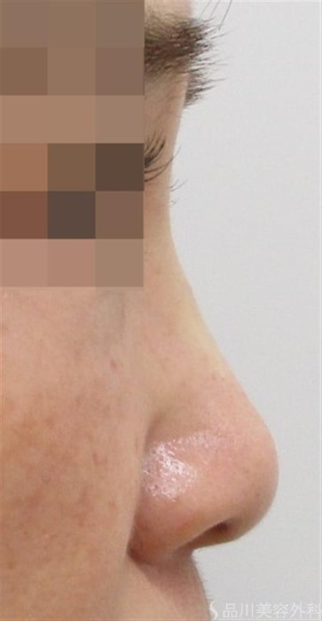 症例NO.44025のAFTER写真