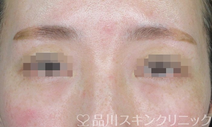 症例NO.63701のBEFORE写真