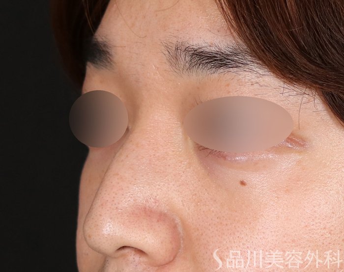 症例NO.71262のBEFORE写真