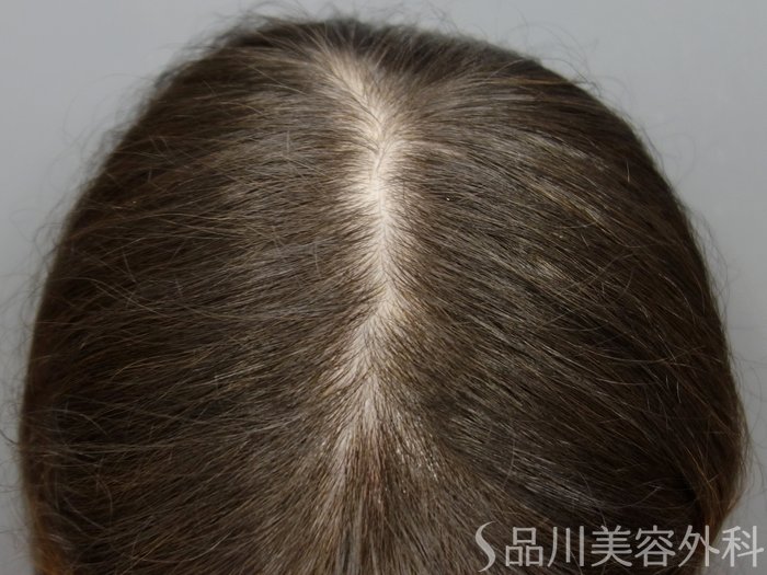 症例NO.72920のBEFORE写真