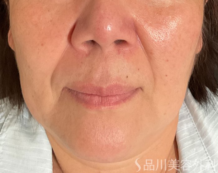 症例NO.75098のBEFORE写真