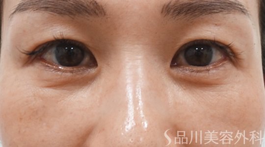 症例NO.70888のAFTER写真