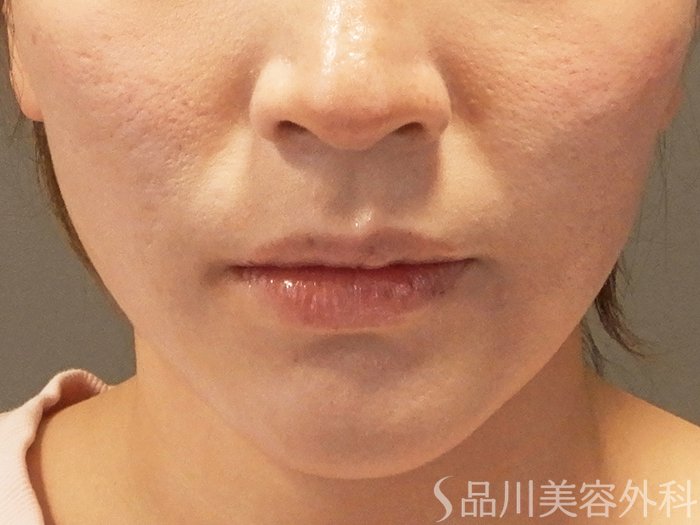 症例NO.69208のAFTER写真